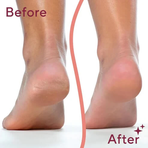 Electric Callus Remover - Rechargeable Foot Care Tool for Dry Skin & Cracked Heels